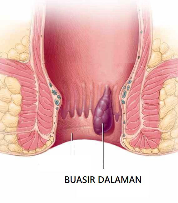 Buasir Dalaman