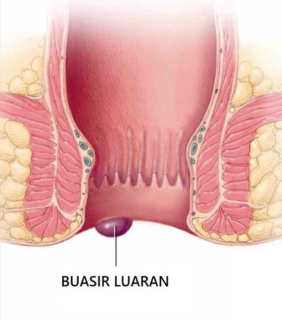 Buasir Luaran